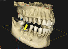歯科用CTで精密診断