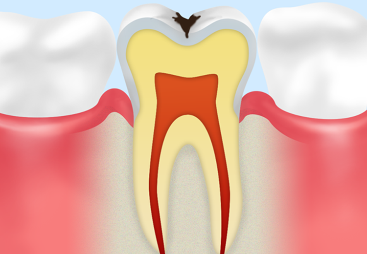 エナメル質の虫歯