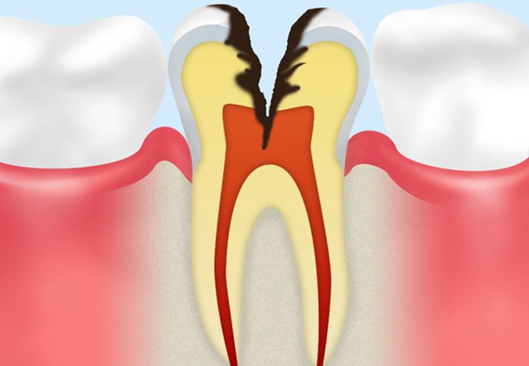 神経まで達した虫歯