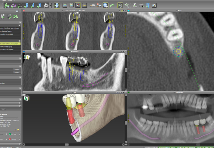 歯科用CTやガイドによる高精度のインプラント治療