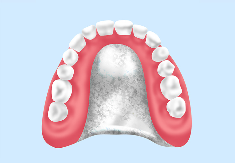 金属床義歯