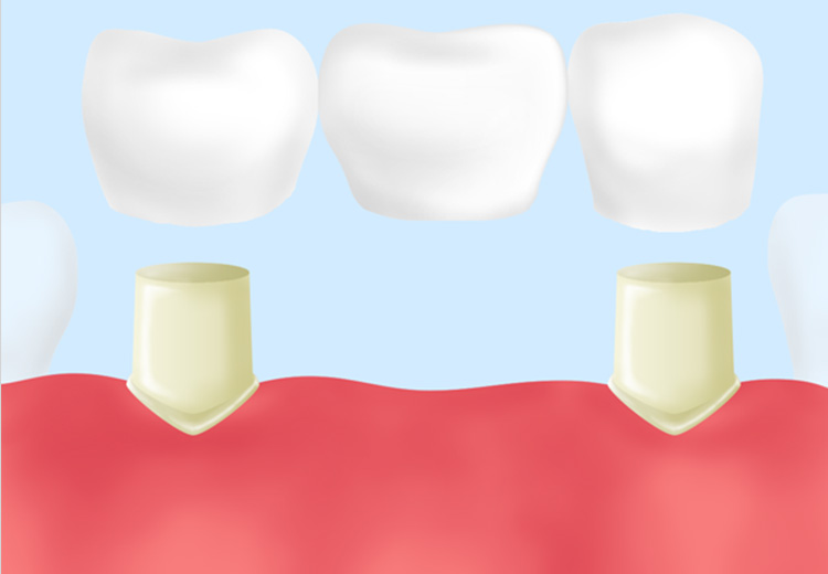 ブリッジ治療とは