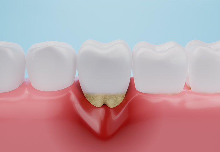 歯周病の症状について