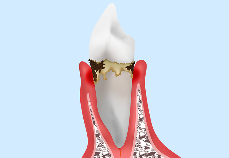 軽度歯周炎