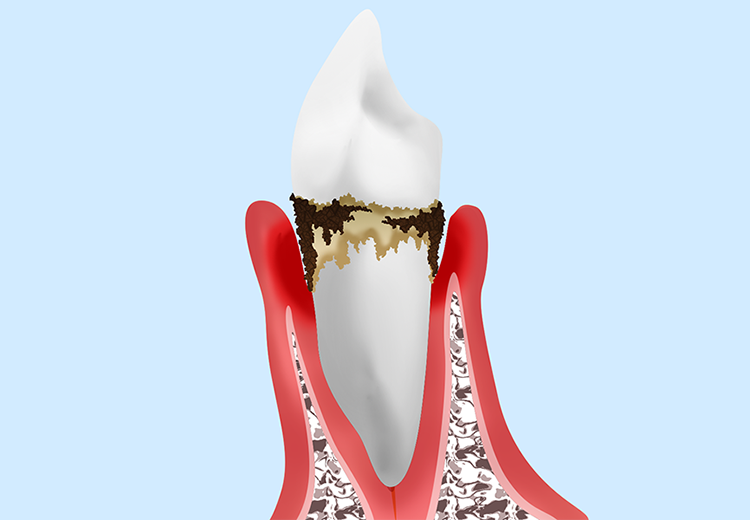 中度歯周炎
