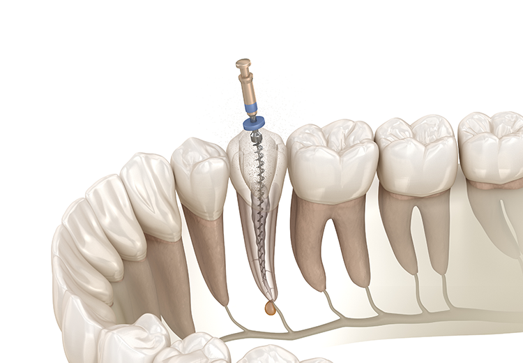根管治療の重要性